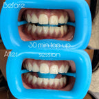 SheGrillz Teeth Whitening