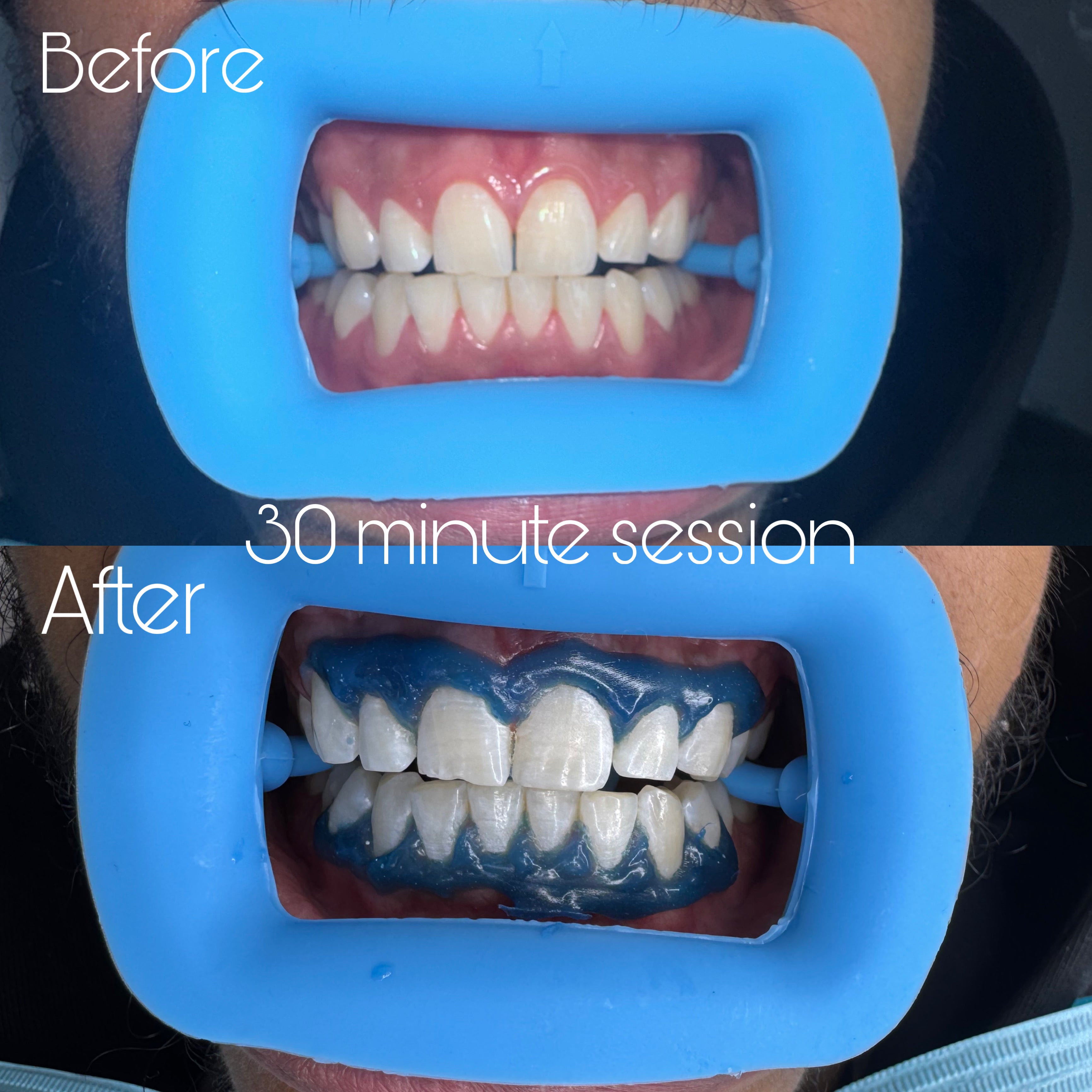 SheGrillz Teeth Whitening