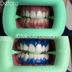 SheGrillz Teeth Whitening