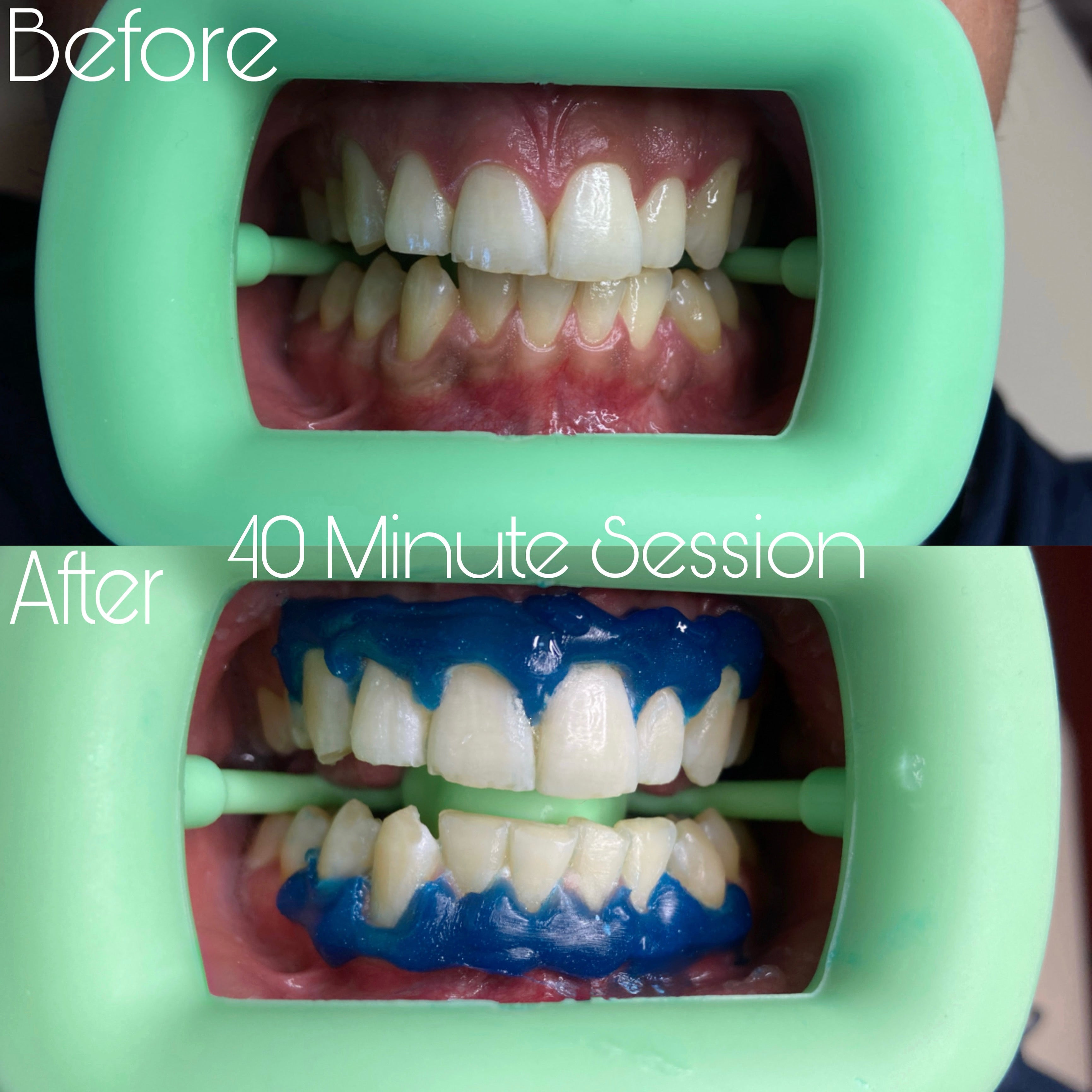 SheGrillz Teeth Whitening