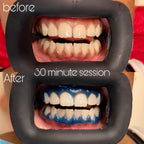 SheGrillz Teeth Whitening