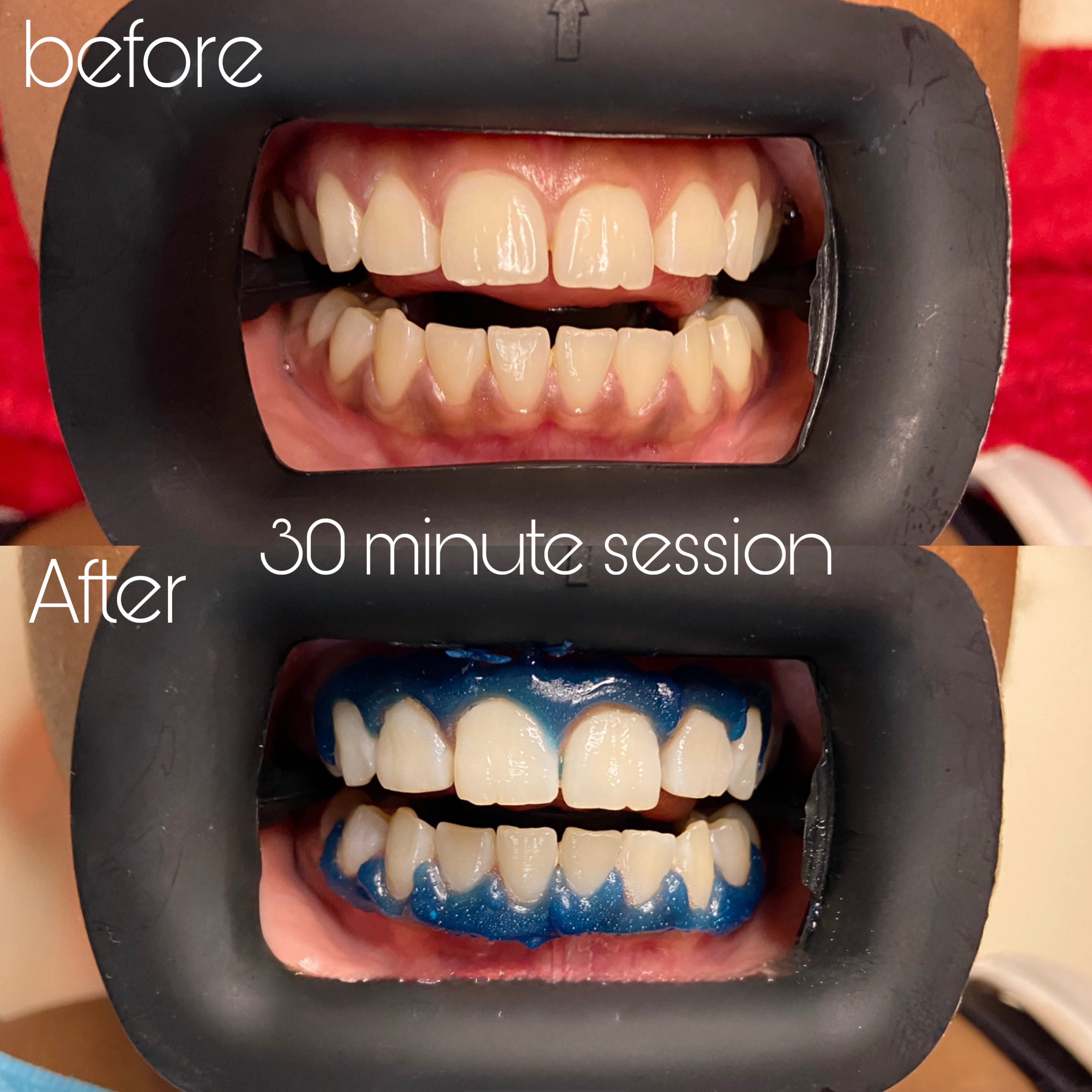 SheGrillz Teeth Whitening